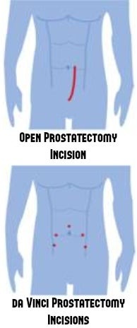 Robotic Surgery for Prostate